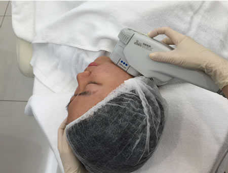Ulthera Anti-Aging Treatment for the Neck