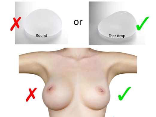 round vs anatomical implant