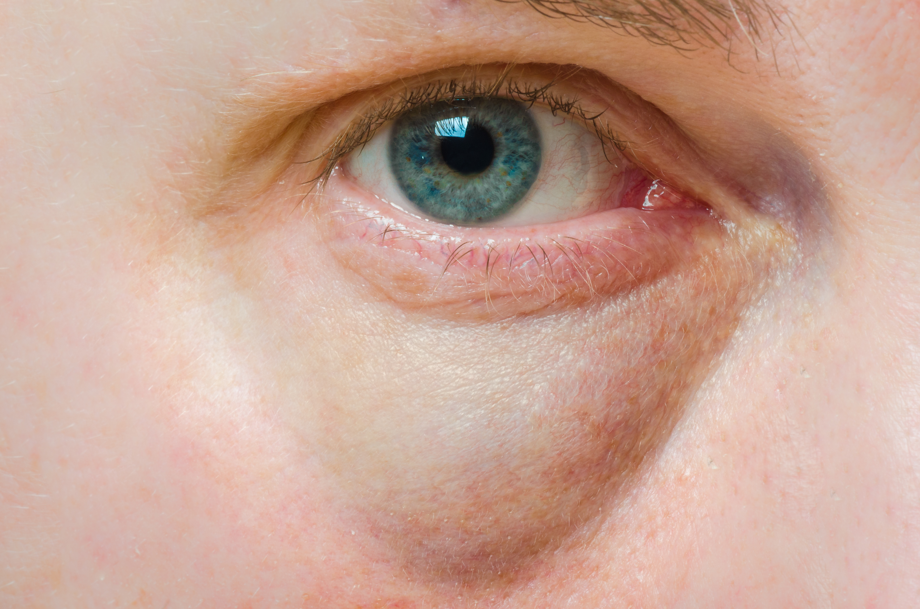 Puffy Swollen Eye
