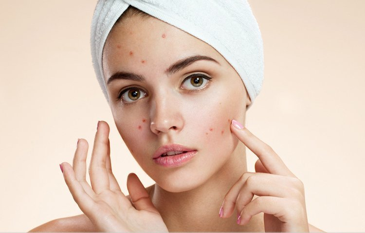 pimple-treatment-for-oily-skin.jpg
