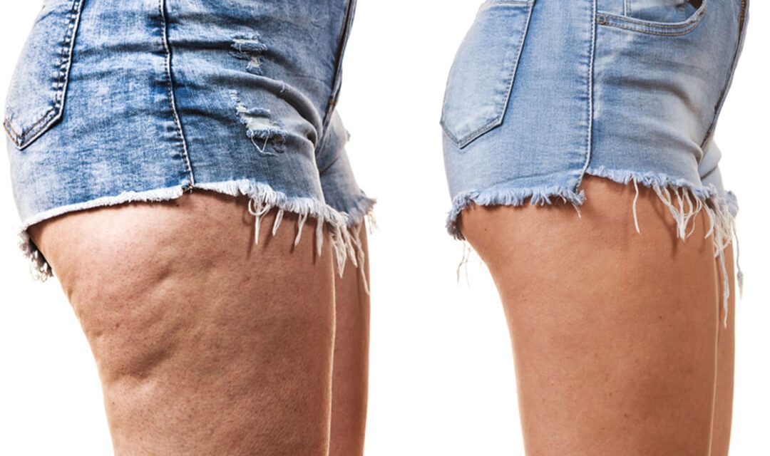 Cellulite-Treatment-Options-and-Before-and-After-Cellulite-Treatments-1080x640