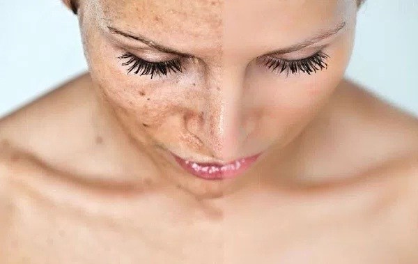 Blackhead-Removal