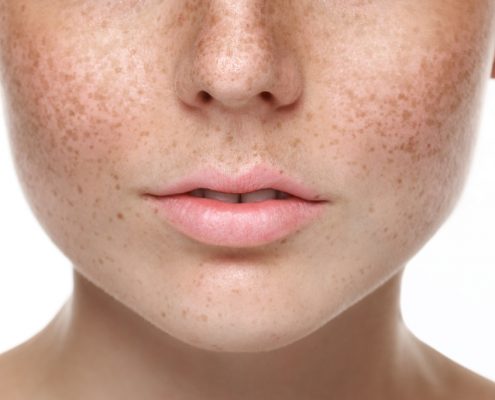 Renude-Freckles-495x400
