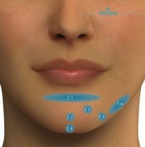 chin fillers
