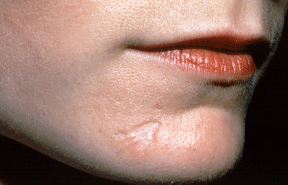 scars-chin-overview