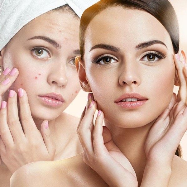 antiacne800x800